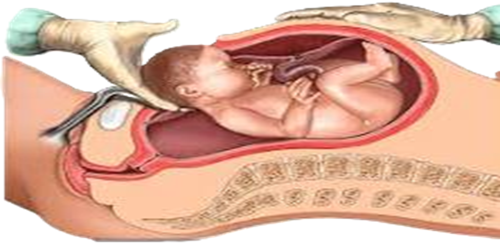 தமிழ்நாட்டில் சிசேரியன் பிரசவங்கள் அதிகரிப்பு – ஆய்வு முடிவுகள் சொல்வது என்ன?